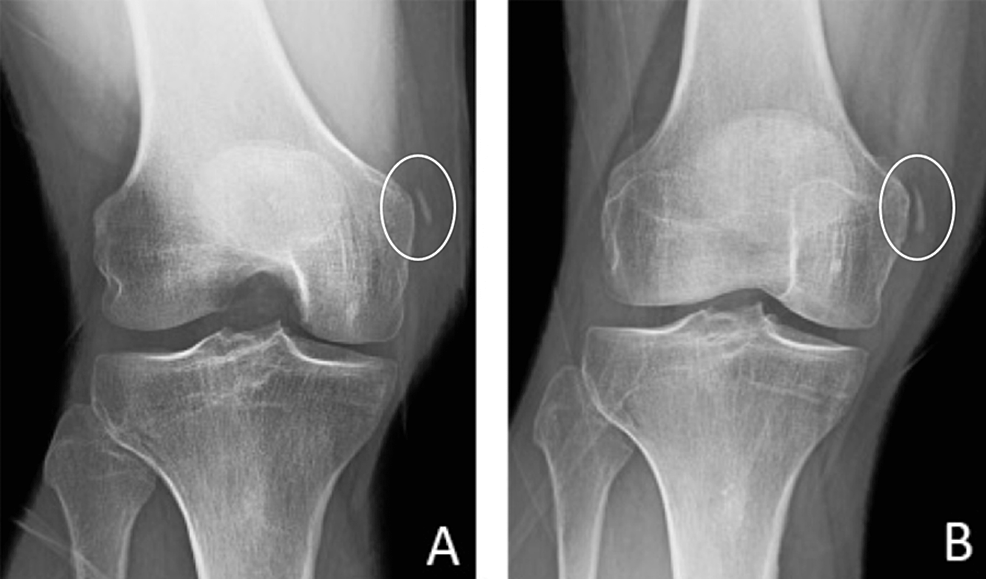 Heterotopic Mineralization Of The Medial Collateral Ligament: Our ...