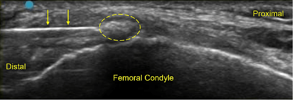 Heterotopic Mineralization Of The Medial Collateral Ligament: Our ...