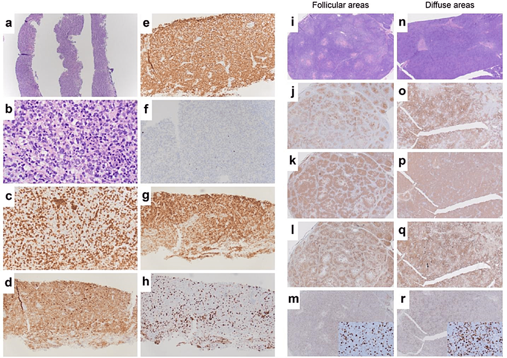 surgical-lymph-node-biopsy-for-the-diagnosis-of-lymphoma-a-case-report