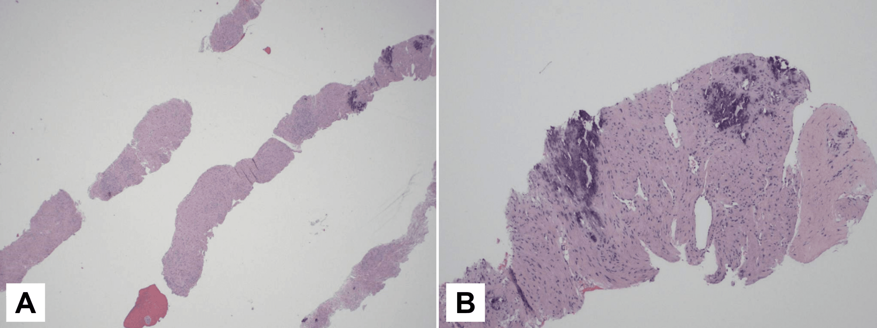 Uterine Angioleiomyoma With Atypia Raised Ca125 Levels And Pseudo 9472