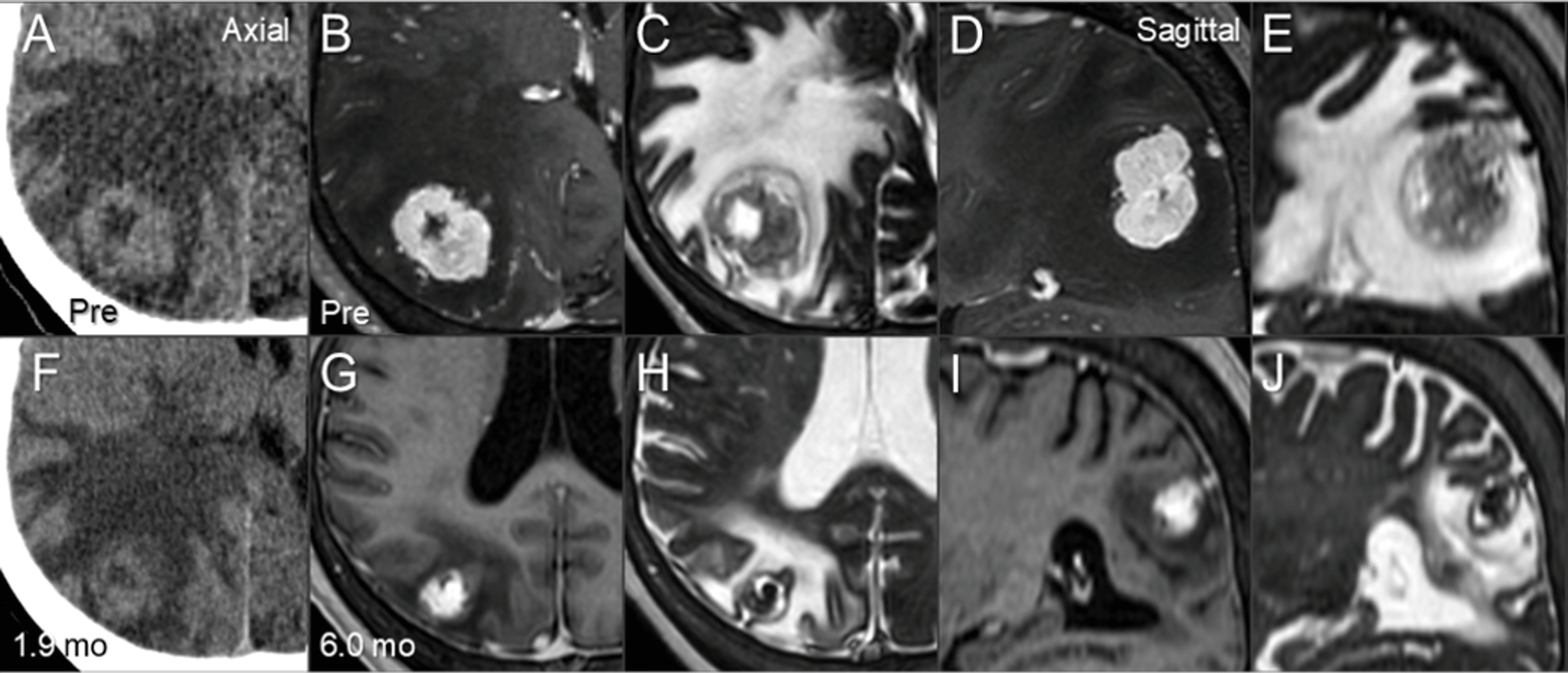 Cureus Gradual and Remarkable Tumor Shrinkage Following Seven