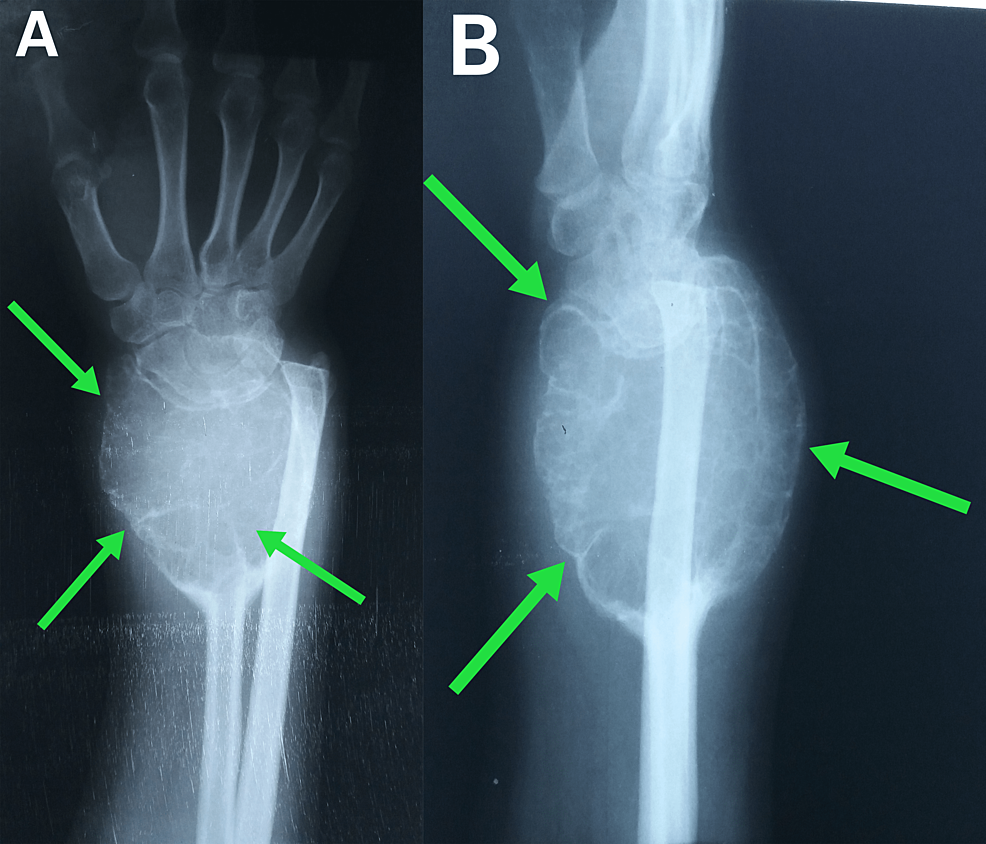 Distal Radius Reconstruction Using Proximal Non-vascularized Fibula ...