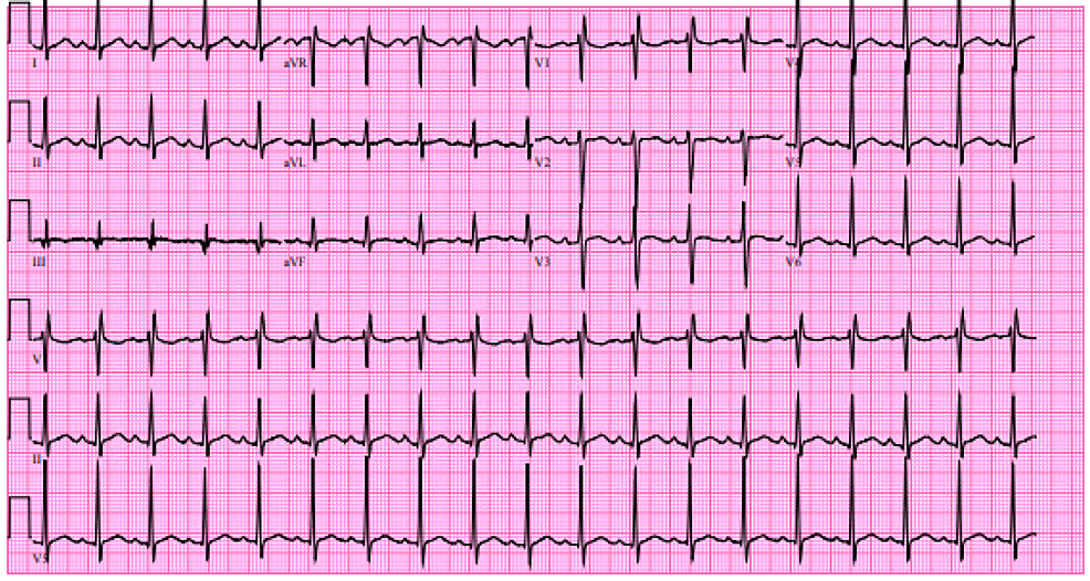 cureus-thyrotoxic-periodic-paralysis-with-severe-hypokalemia