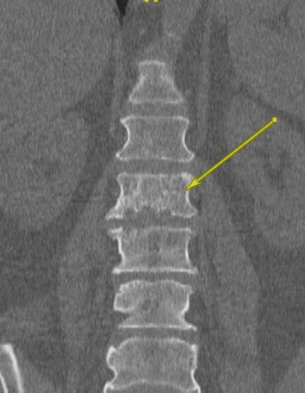 Cureus Preresection Embolization of a Focal Lumbar Chordoma