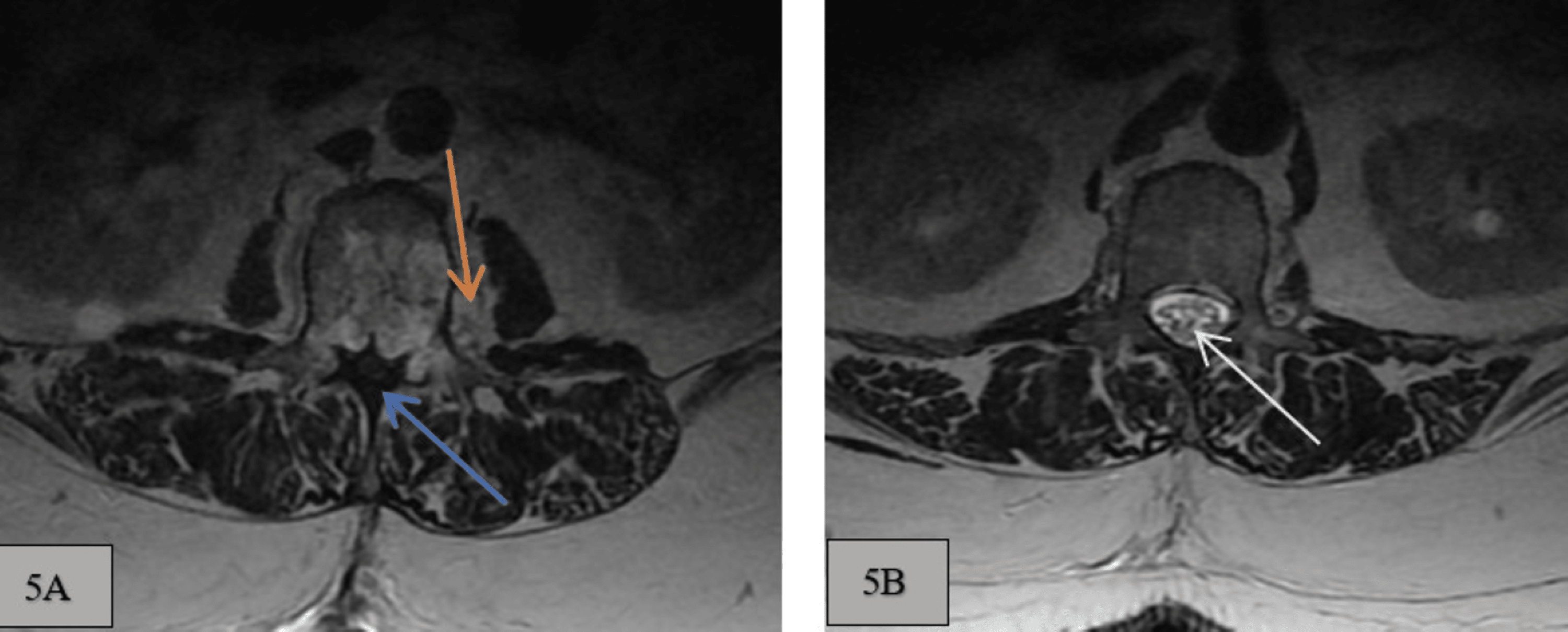 Cureus | Pre-resection Embolization of a Focal Lumbar Chordoma