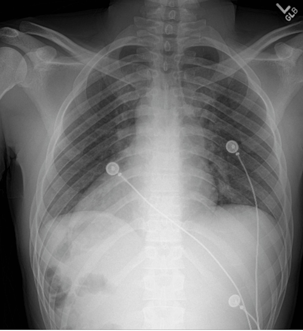 Cureus | A Rare Case of Weil’s Syndrome With Extreme Hyperbilirubinemia ...