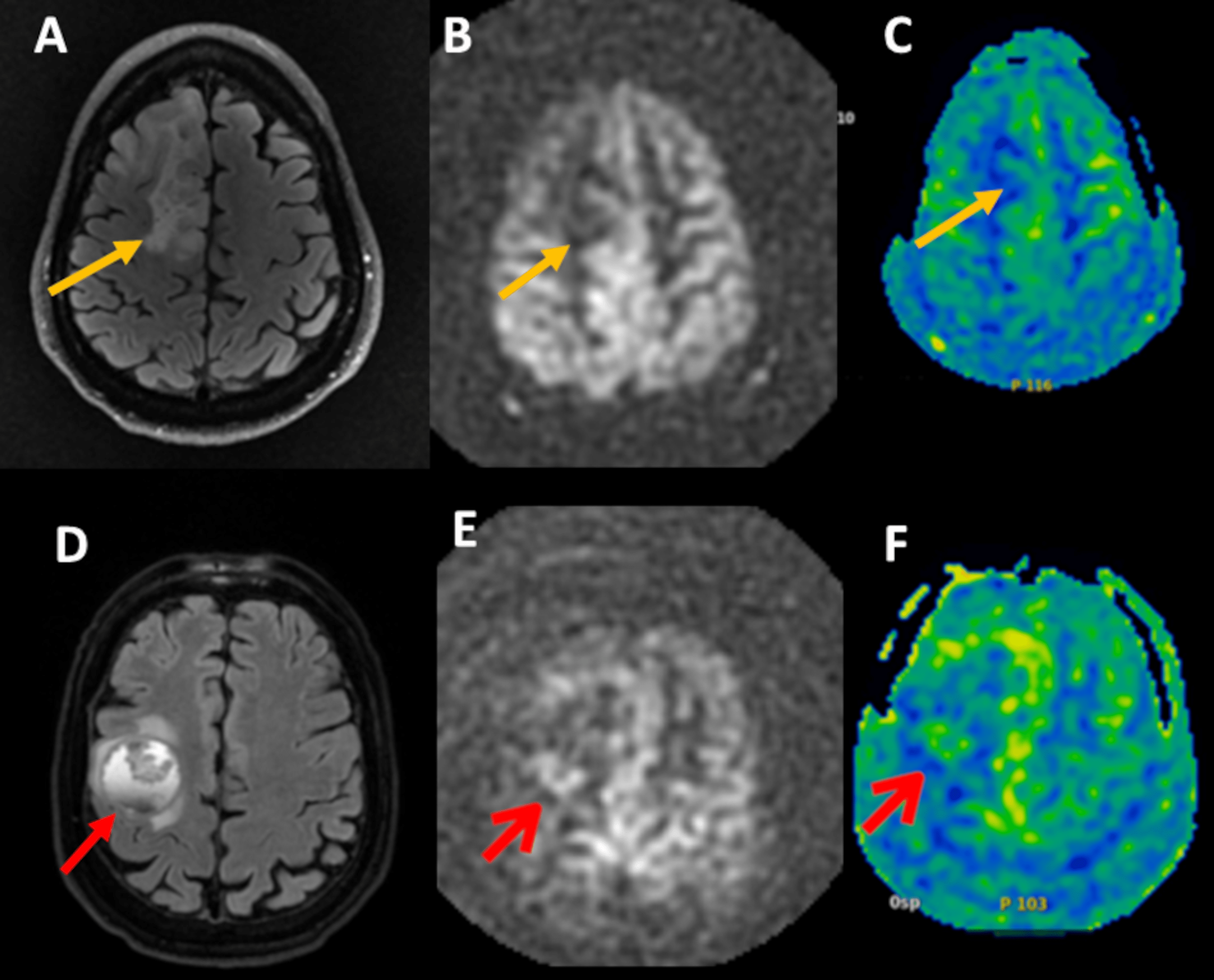 Cureus Radiological Biomarkers for Brain Metastases Prognosis Quantitative Resonance