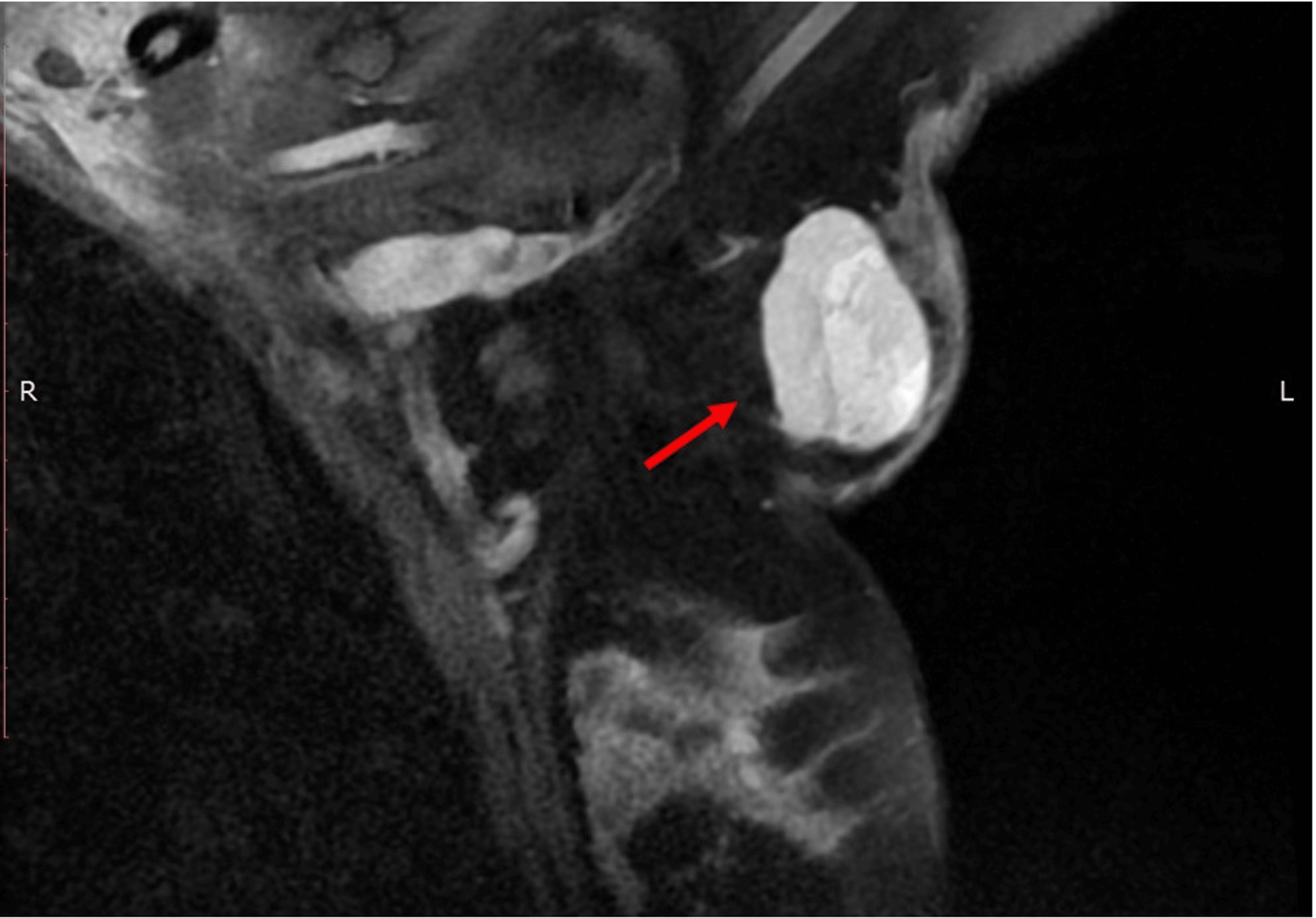 Fibroadenoma Arising In Axillary Ectopic Breast Tissue A Diagnostic Challenge Cureus