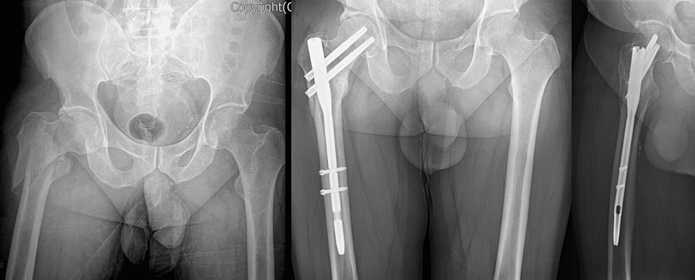 How Is A Oblique Fracture Treated