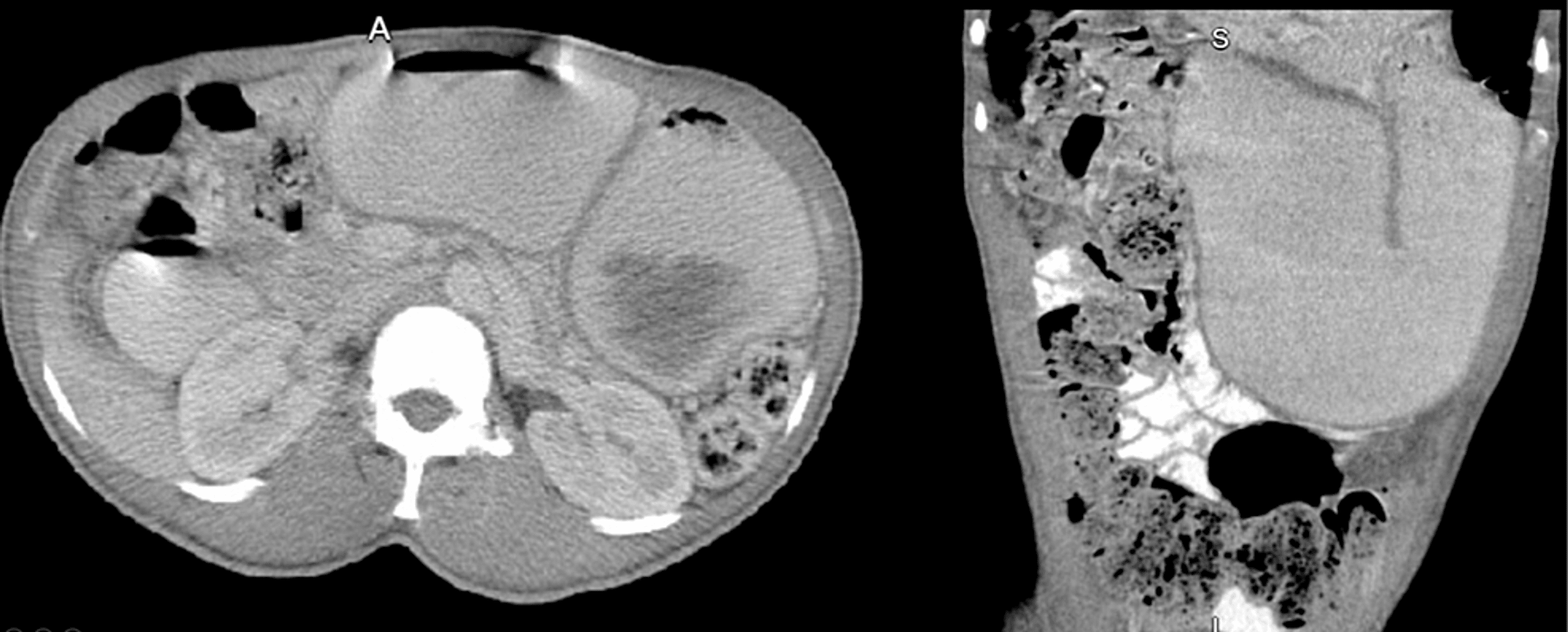 Distal Gastrectomy With RouxenY Reconstruction for a Seriously