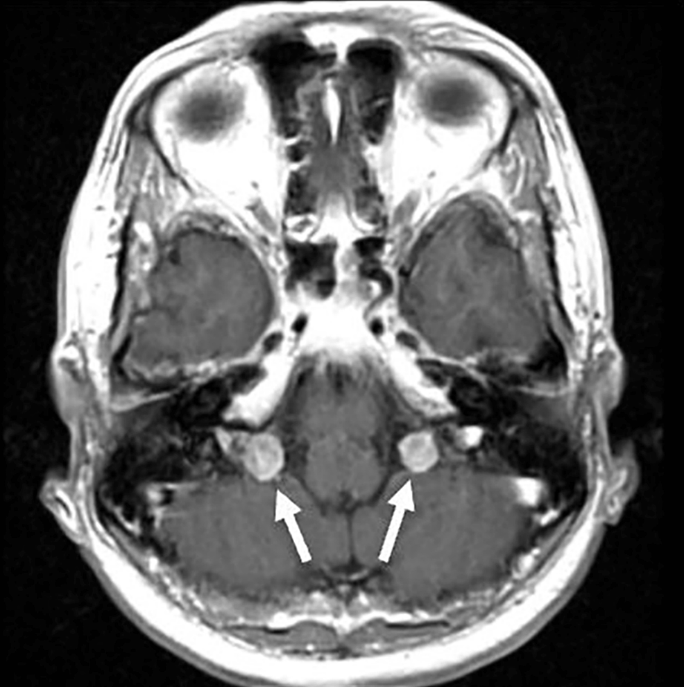 cureus-bilateral-vocal-fold-paralysis-in-a-patient-with