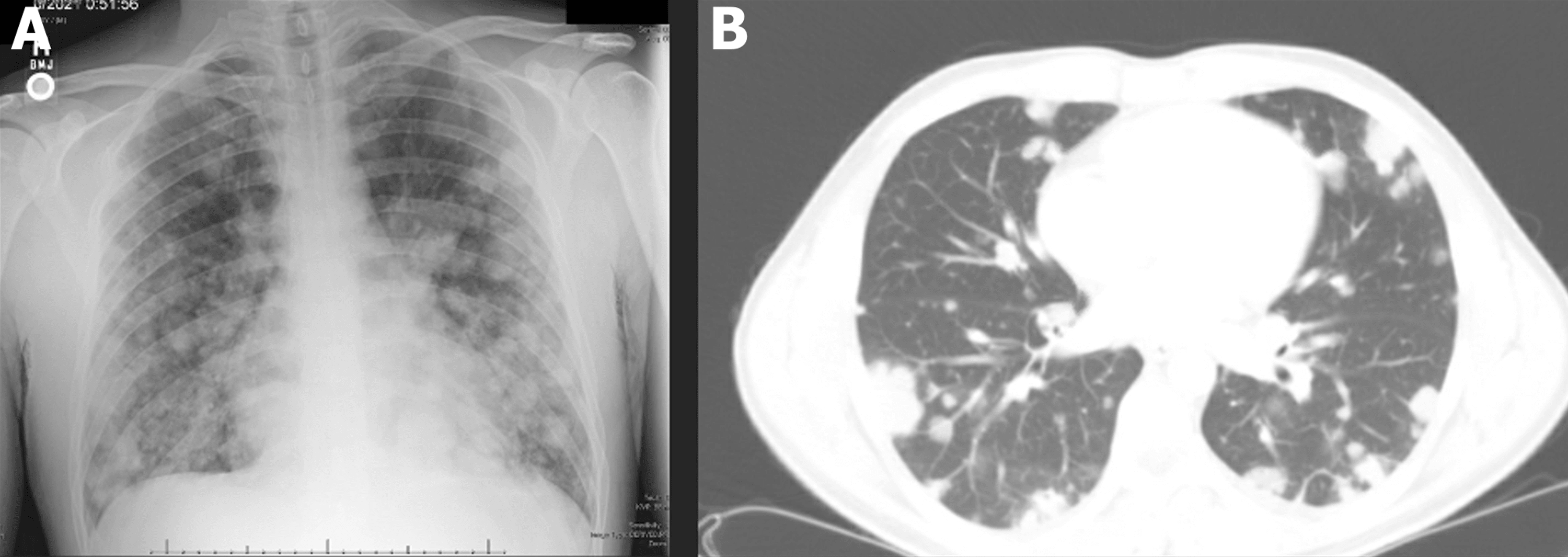 Cureus Medical Literature Writing With ChatGPT A Rare Case of