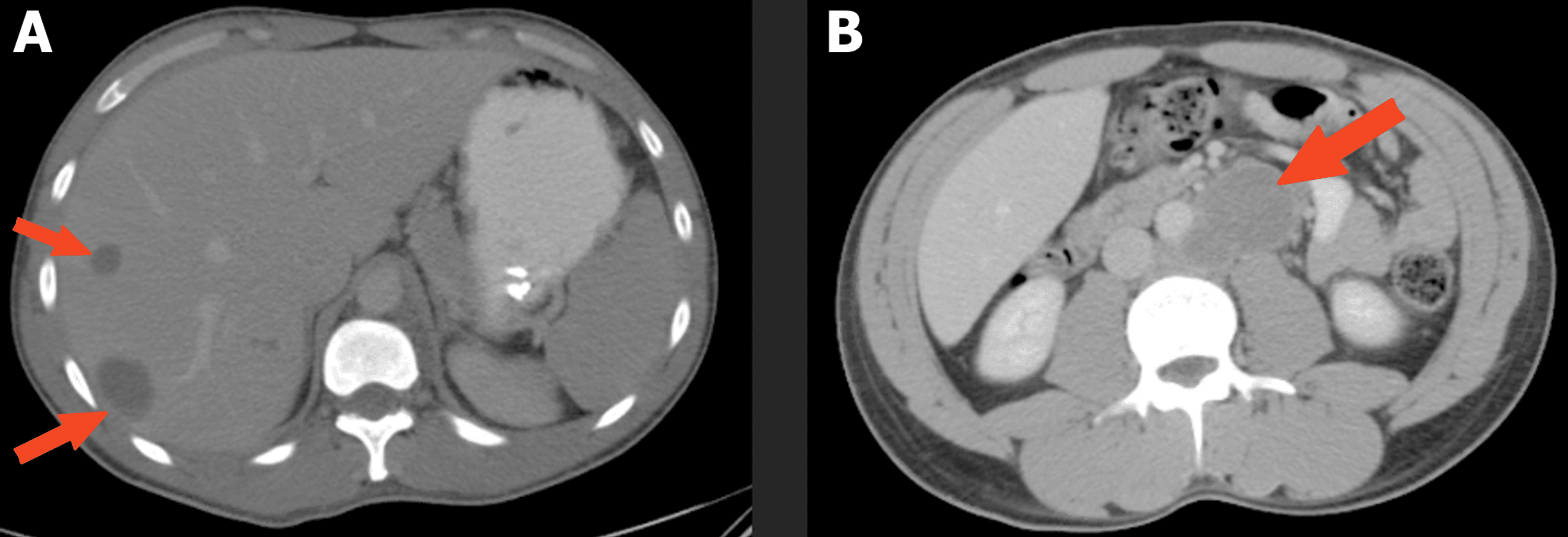 Cureus Medical Literature Writing With ChatGPT A Rare Case of
