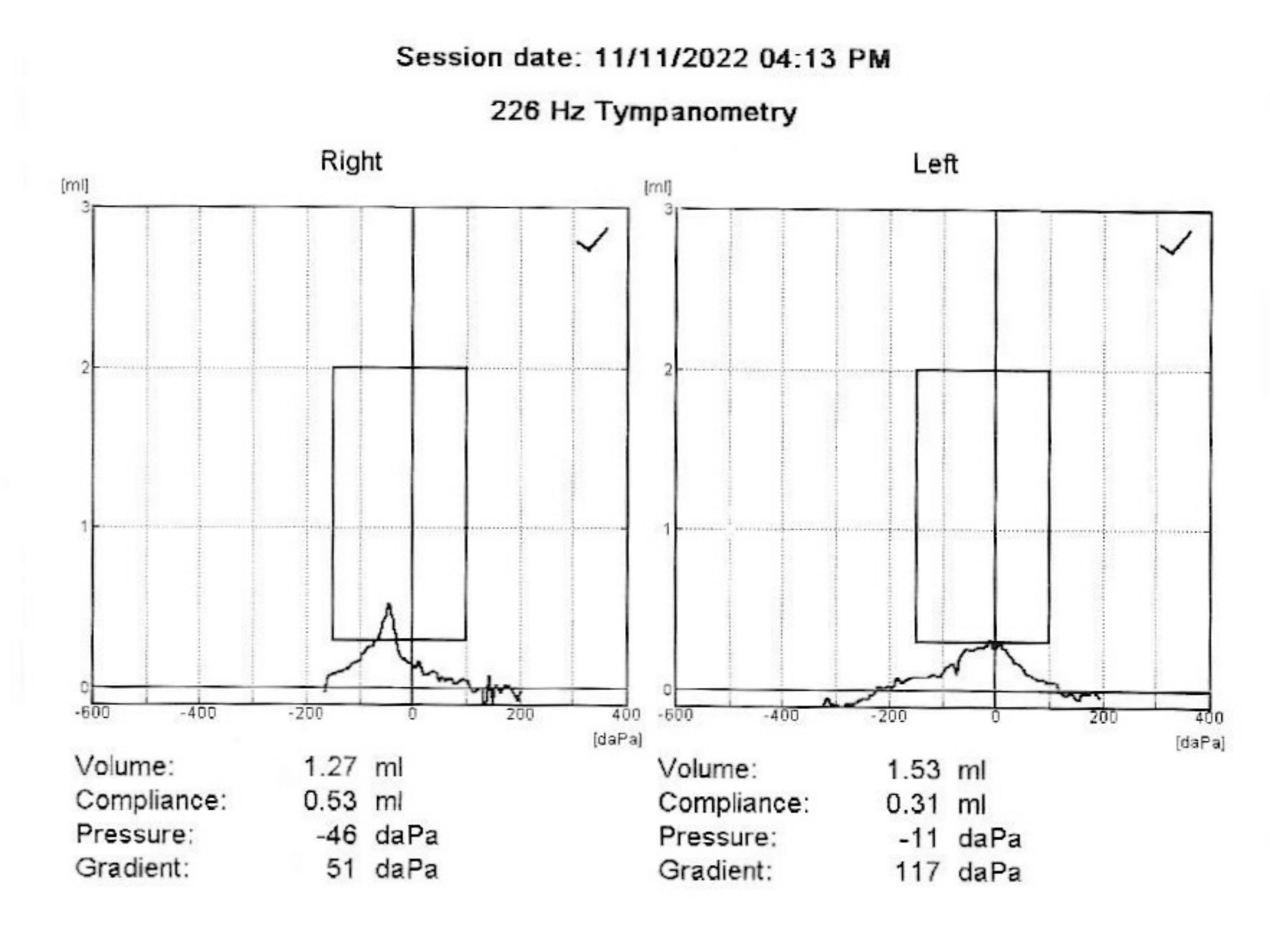 A Case Report on GroundLevel Alternobaric Vertigo Due to Eustachian