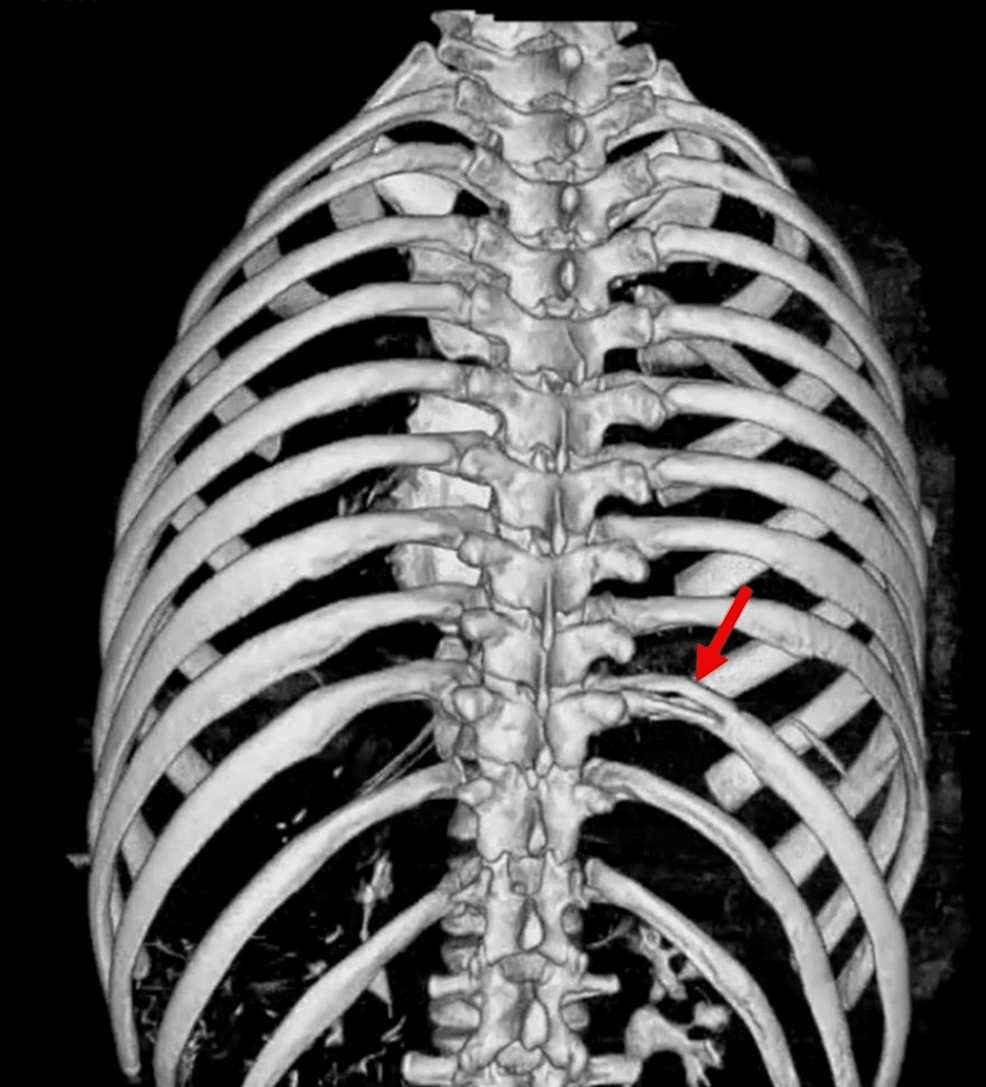 Cureus Blunt Trauma and Right Diaphragmatic Rupture Unveiling the Impact