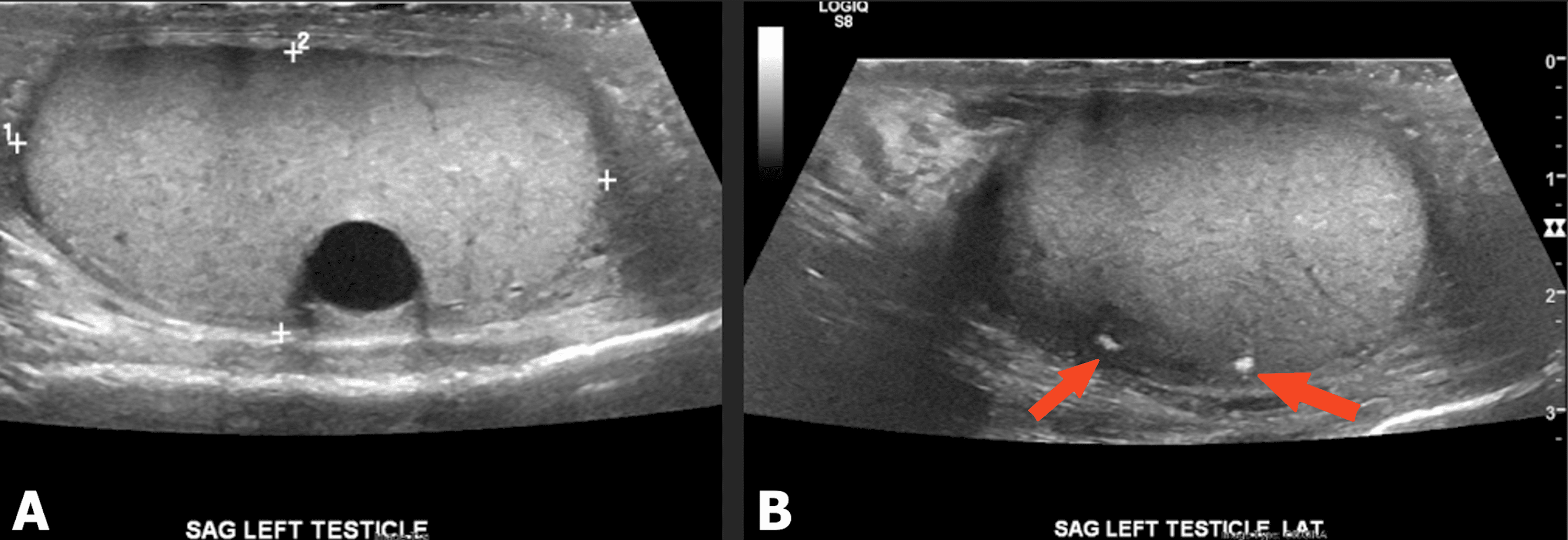 Medical Literature Writing With ChatGPT A Rare Case of Choriocarcinoma