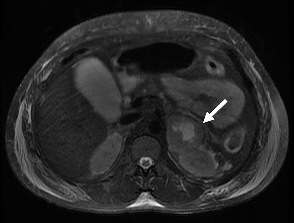 Cureus Liver Transplantation for Fulminant Hepatic Failure