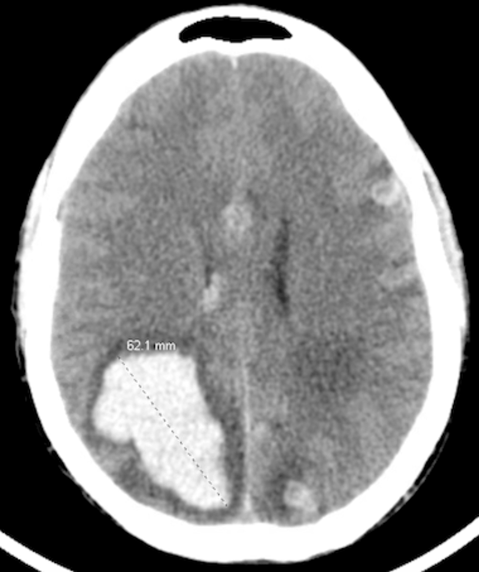 Cureus Medical Literature Writing With ChatGPT A Rare Case of