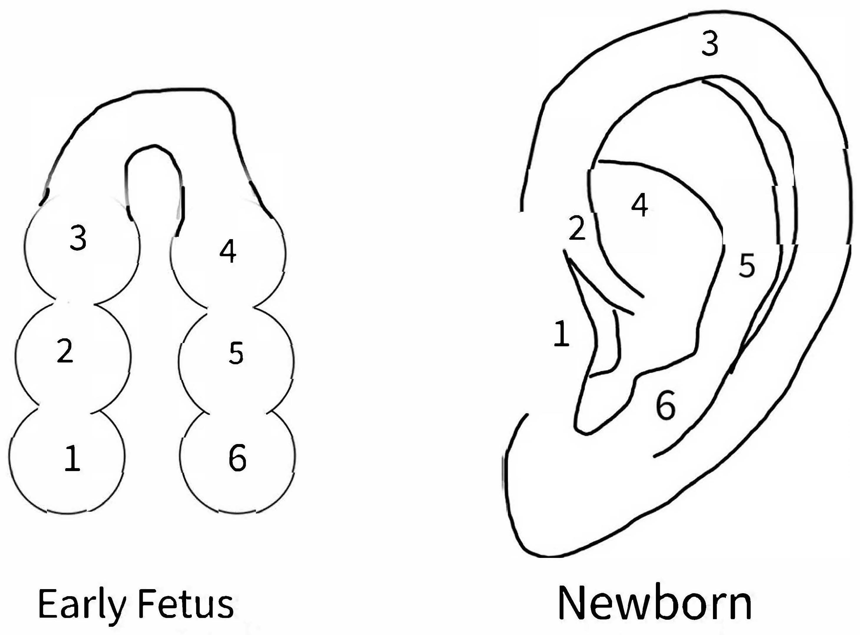 Ectopic Unilateral Ear Pit in an Otherwise WellAppearing Child A Case