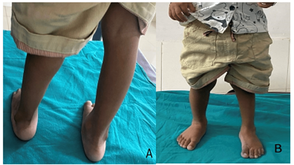 Cureus A Prospective Study on Functional of Serial Cast