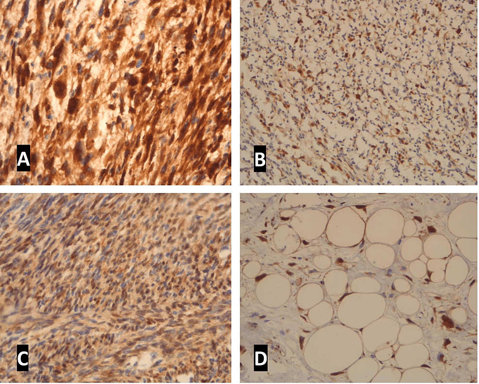 Cureus Immunohistochemical Expression of p16 and CDK4 in Soft Tissue