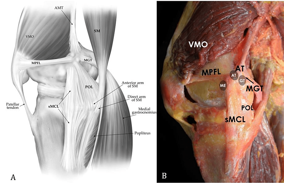 Medial collateral ligament (MCL) injury. Arrow points to a superficial