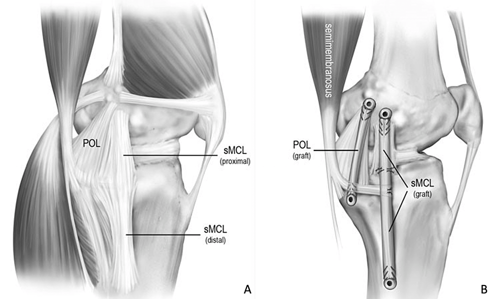 MedialSided Ligamentous Injuries of the Athlete's Knee Evaluation and
