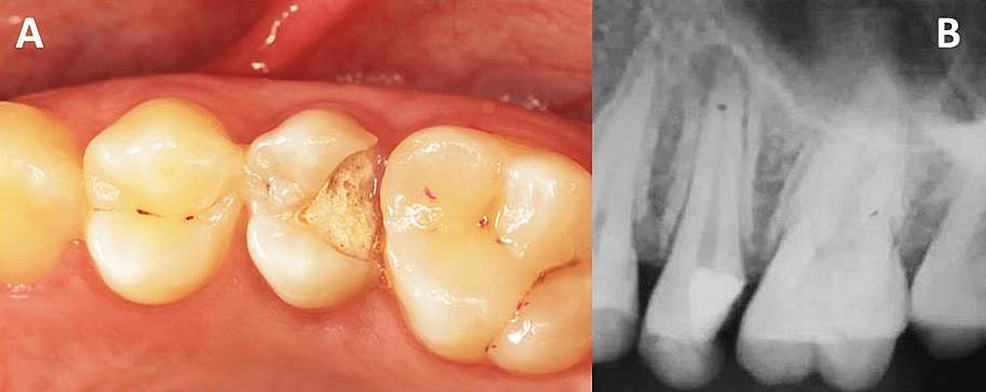 Prior Restorative Procedures To Endodontic Treatment | Cureus