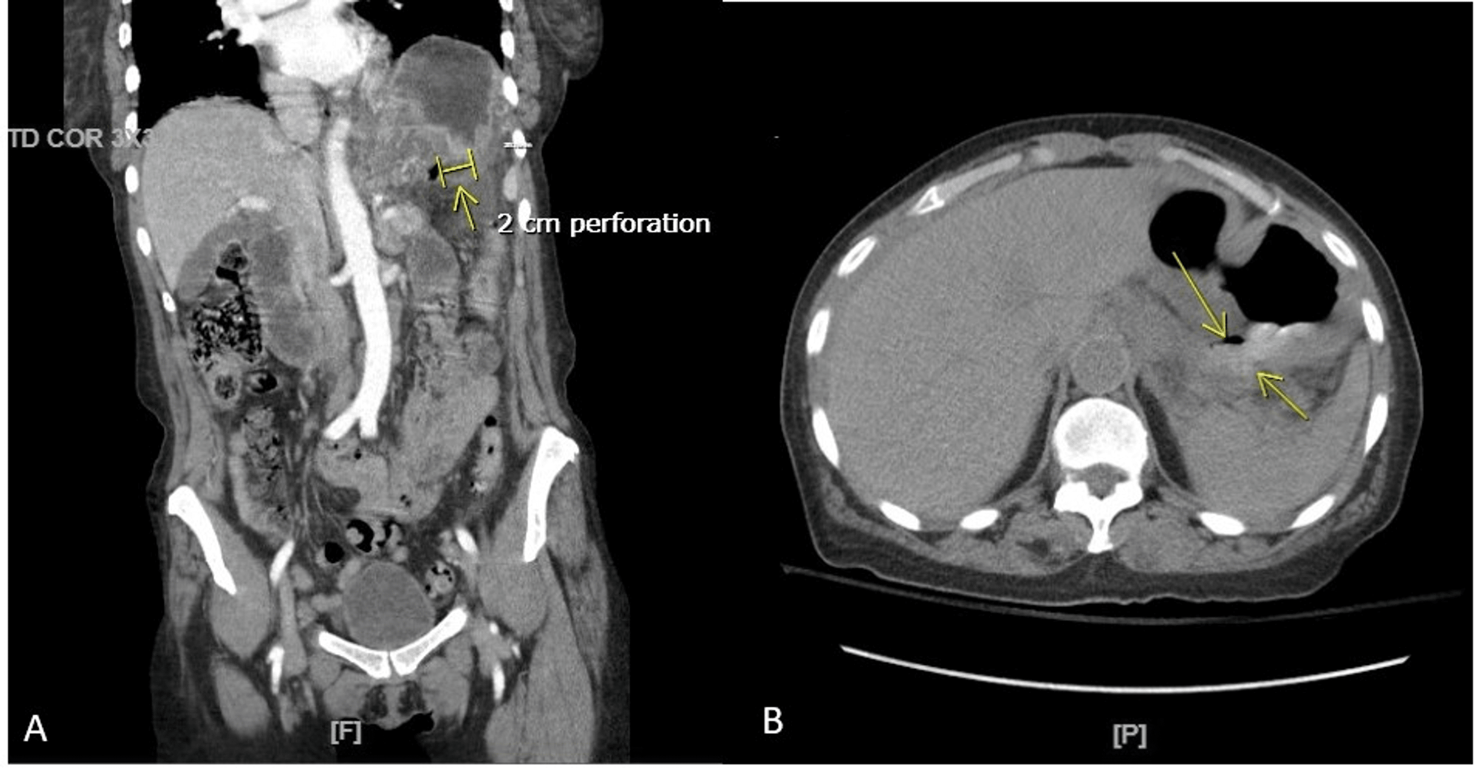 Cureus Chronic Lymphocytic Leukemia Causing Gastric Ulcer Perforation