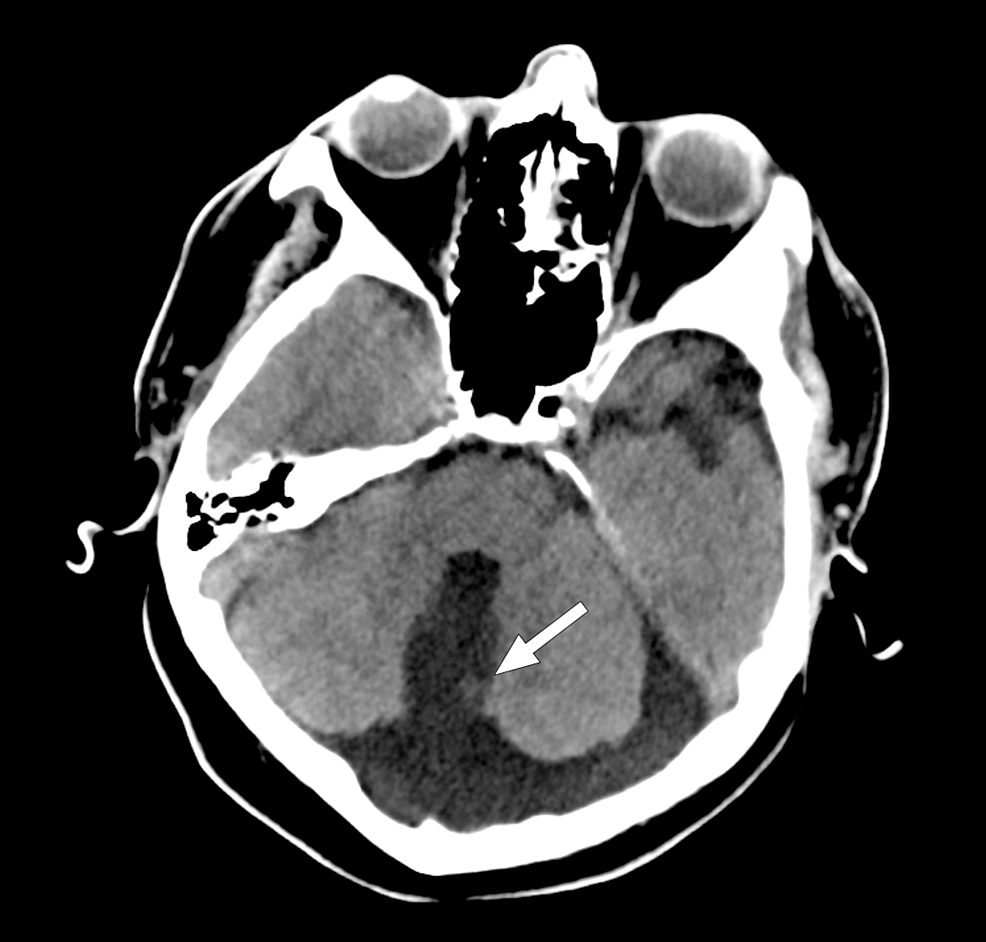 Adult Radiographic Presentation Of Corpus Callosal Agenesis With A Single Interhemispheric Cyst