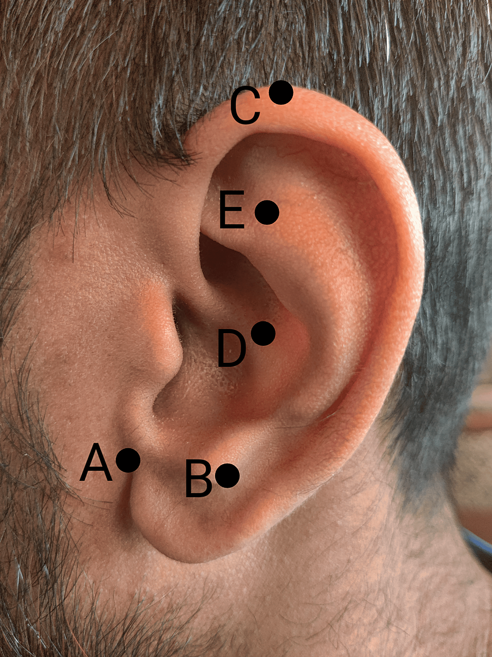 Battlefield Acupuncture for the Treatment of Chronic Migraines Cureus