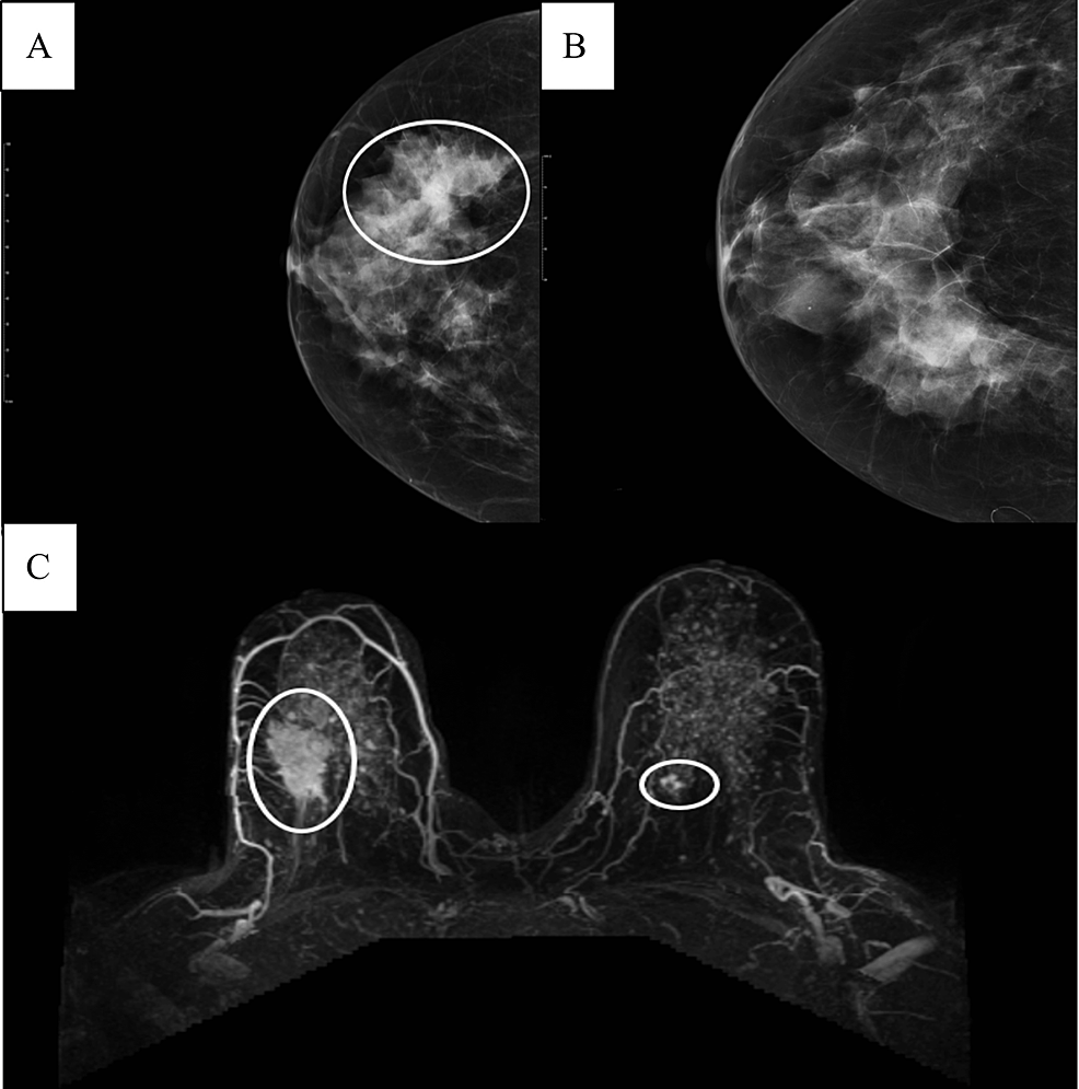 Cureus  Synchronous Bilateral Breast Cancer: A Case Report