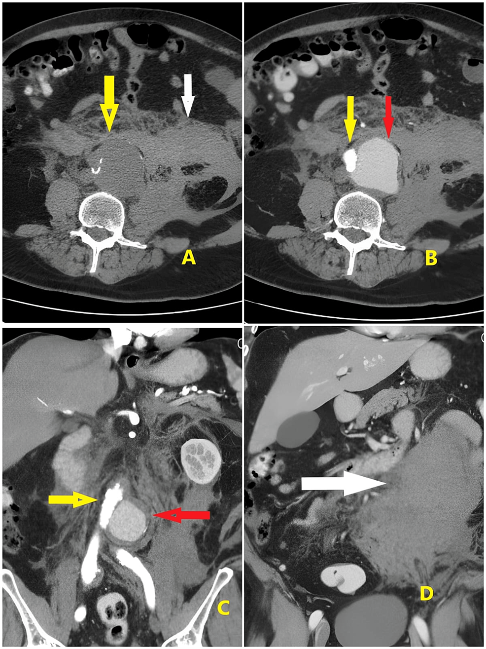 (A)-Plain-CT-of-the-aorta-without-contrast-(yellow-arrow)-and-surrounding-hematoma-(white-arrow),-(B-and-C)-the-true-lumen-(yellow-arrow)-and-the-false-lumen-(red-arrow),-and-(D)-a-huge-retroperitoneal-hematoma-(white-arrow)
