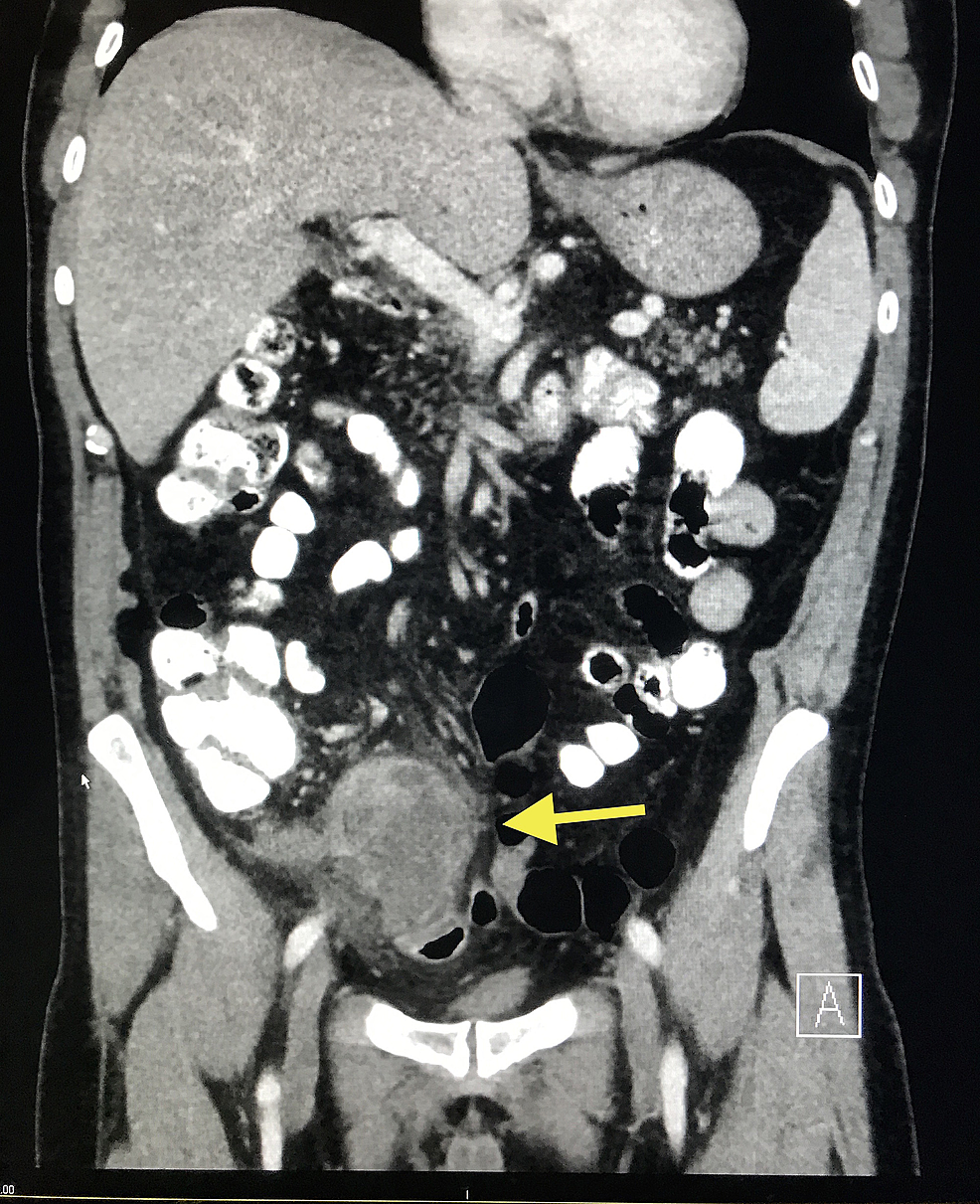 Featured image of post Appendicular Abscess Radiopaedia Appendicular abscess br med j 1956