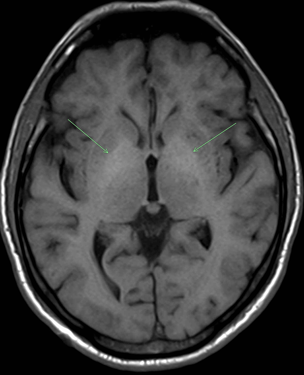 Cureus A Case of Noncirrhotic Hyperammonemic Encephalopathy in a
