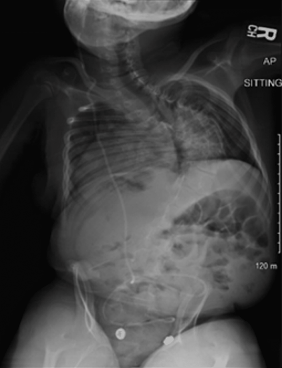 Autofusion With Controlled Growing Rods A Case Report Cureus