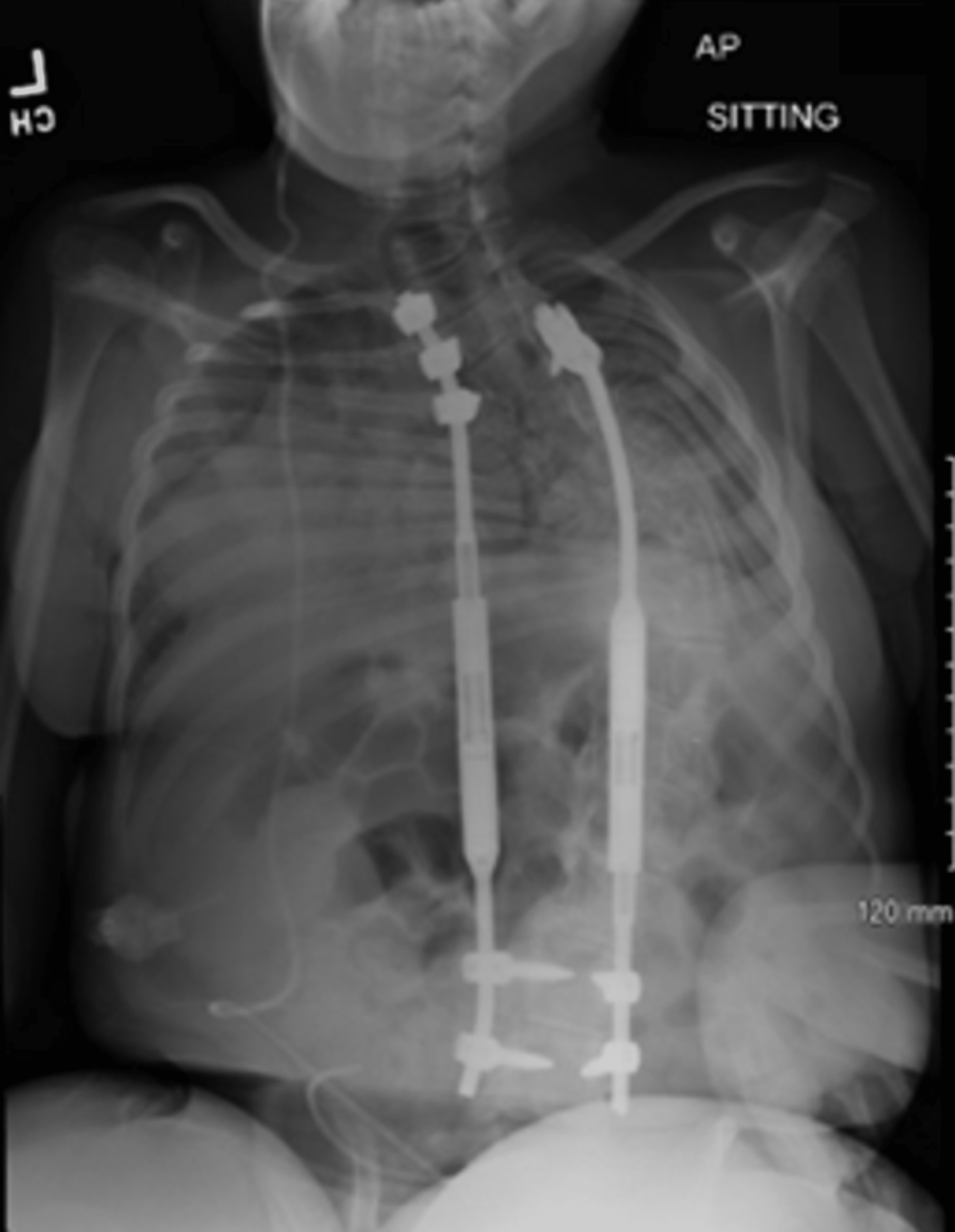 Autofusion With Controlled Growing Rods A Case Report