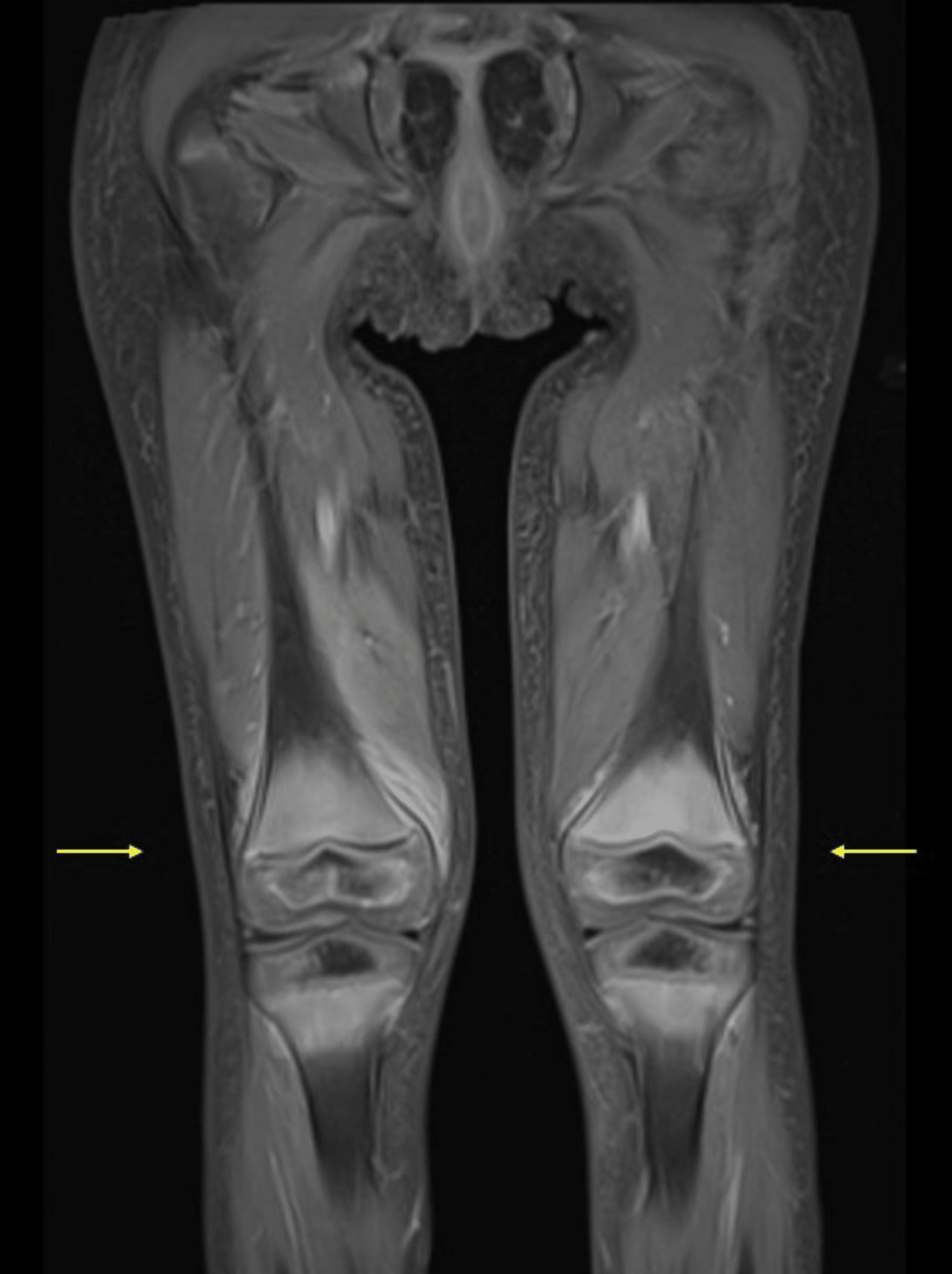 Cureus | Scurvy In A Pediatric Patient Unable To Bear Weight: A Case Report