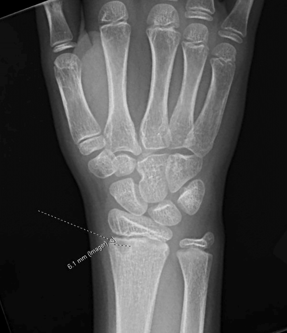 Case Presentation Of A Nine Year Old Female With Chronic Recurrent 