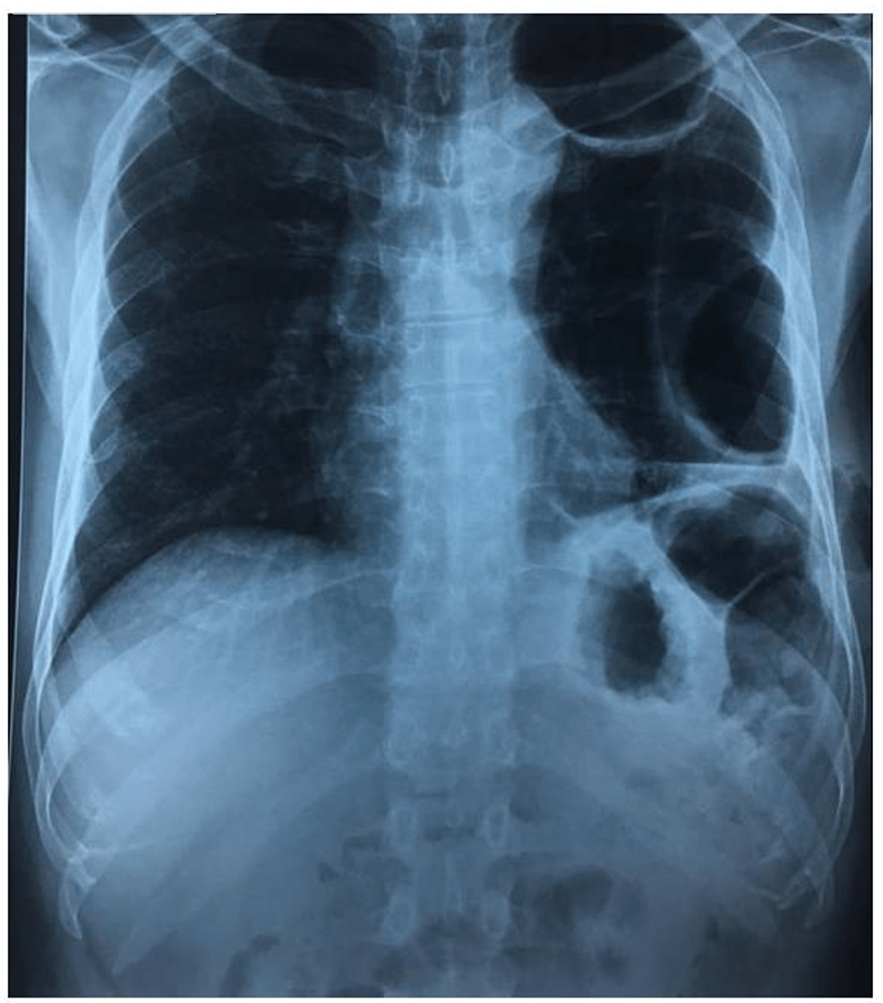 Cureus Pleural Empyema Due To Proteus Mirabilis In An Adult A Rarely Encountered Clinical