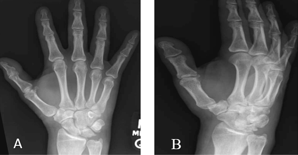 A Rare Case of Carpal Osteomyelitis in a Spinal Cord Injury Patient: A ...