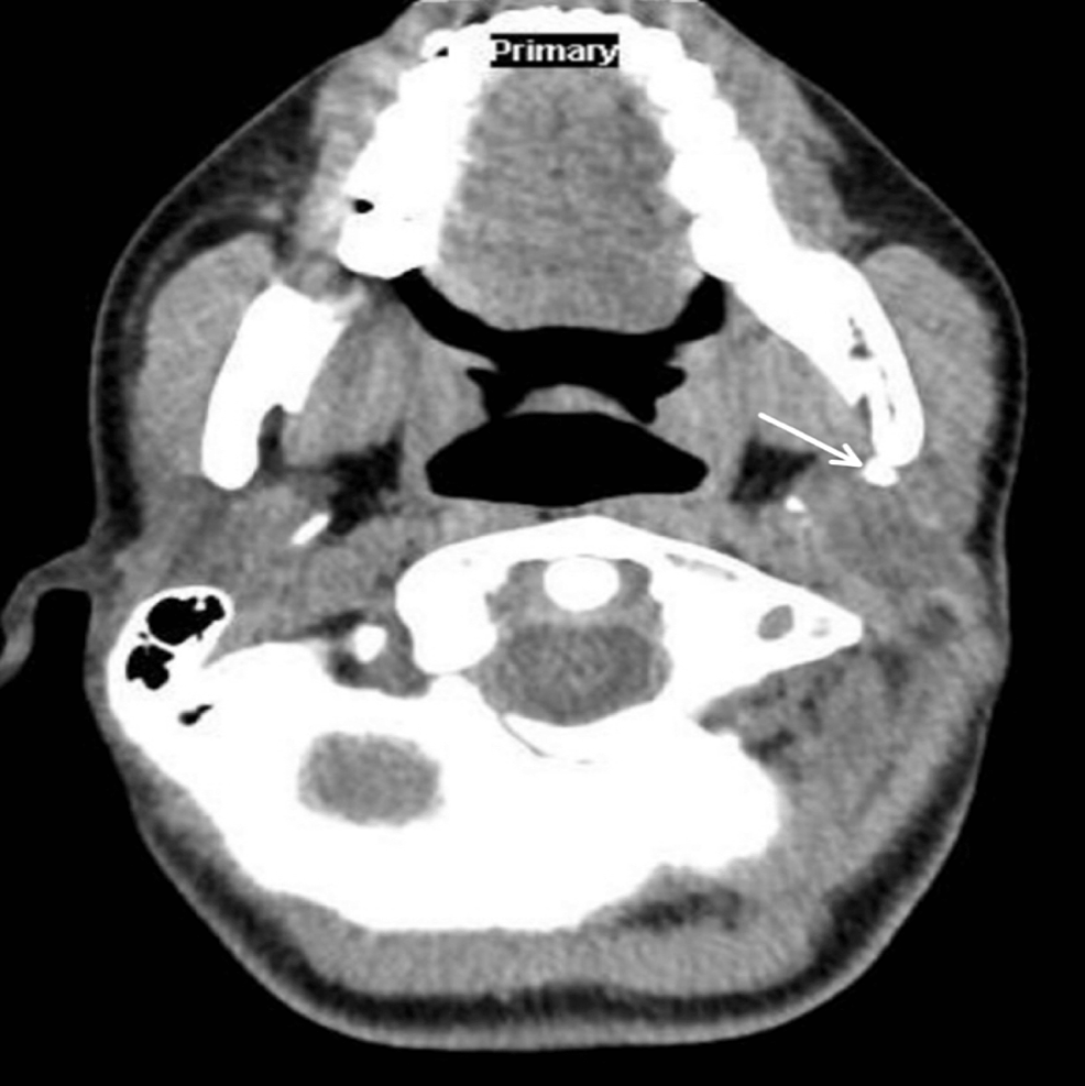 Cureus | Parotid Sialolithiasis in a 17-Year-Old Girl