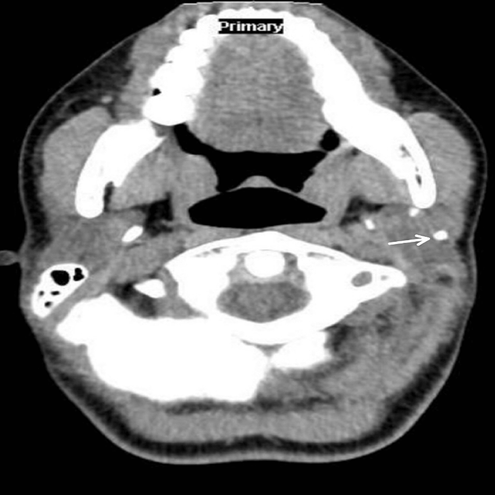 cureus-parotid-sialolithiasis-in-a-17-year-old-girl