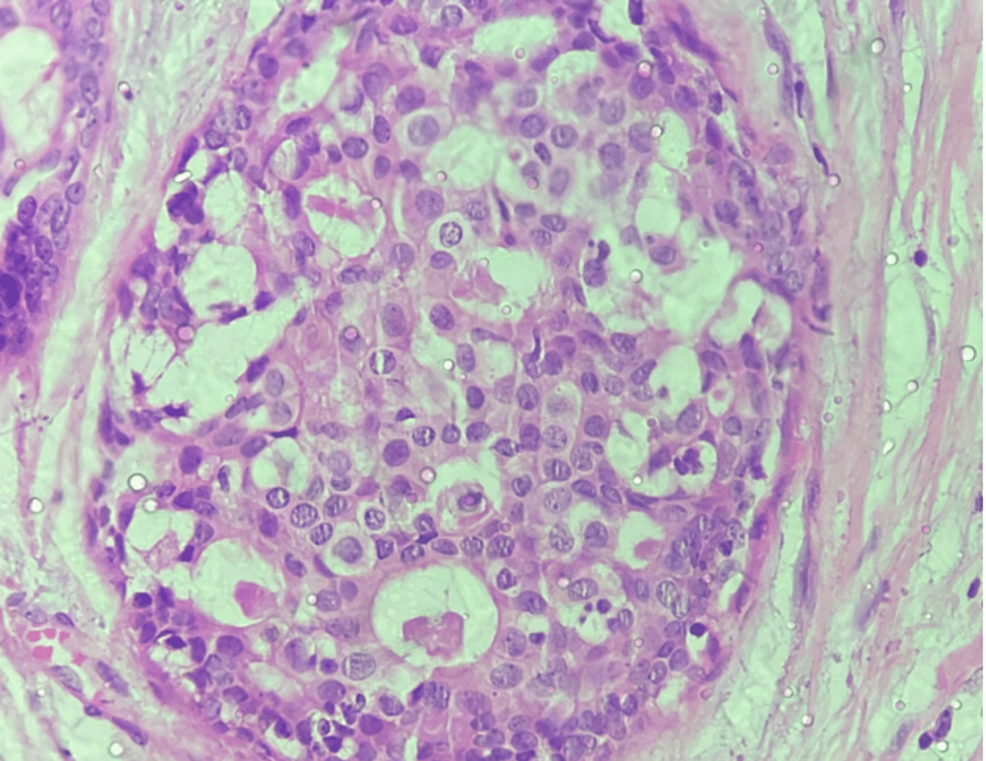 Ductal Carcinoma In Situ A Detailed Review Of Current Practices Cureus ductal-carcinoma-in-situ-a-detailed-review-of-current-practices-cureus