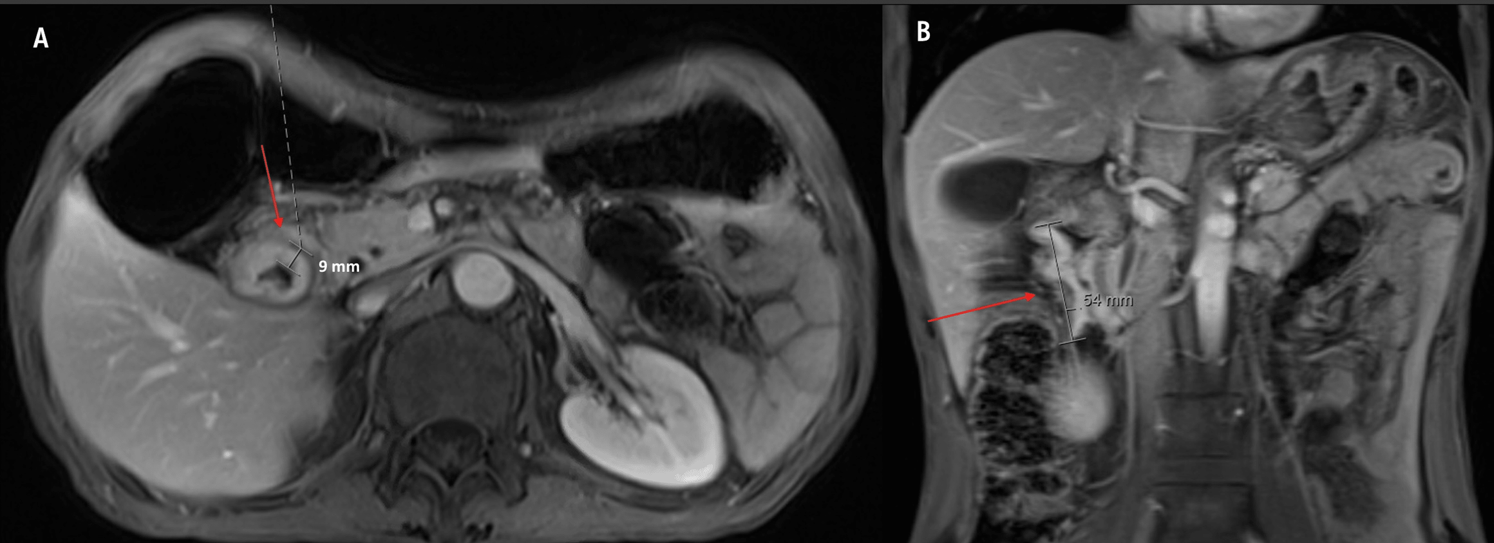 A Rare Case Of Guillain-Barré Syndrome Post-gastrojejunostomy And ...