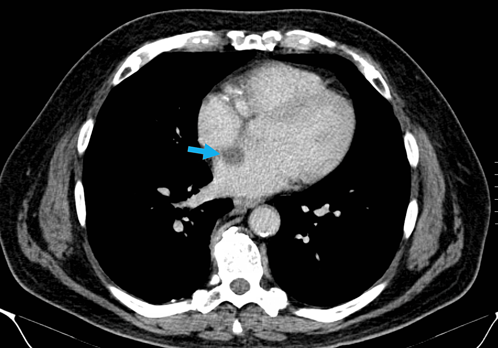 Cureus | Diagnosis and Treatment of Cardiac Myxoma