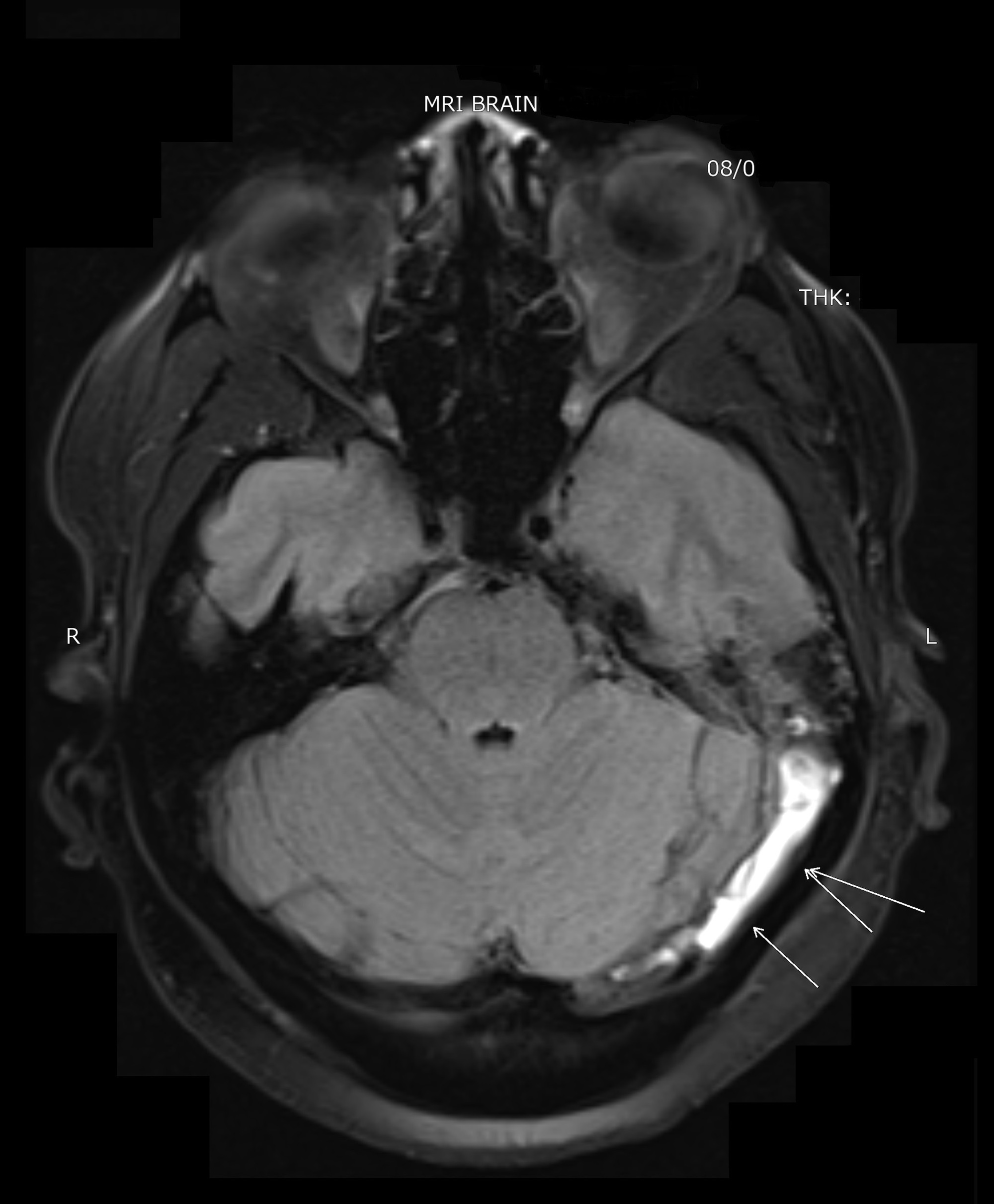 Cureus | Cerebral Sinus Venous Thrombosis in the Setting of Acute ...