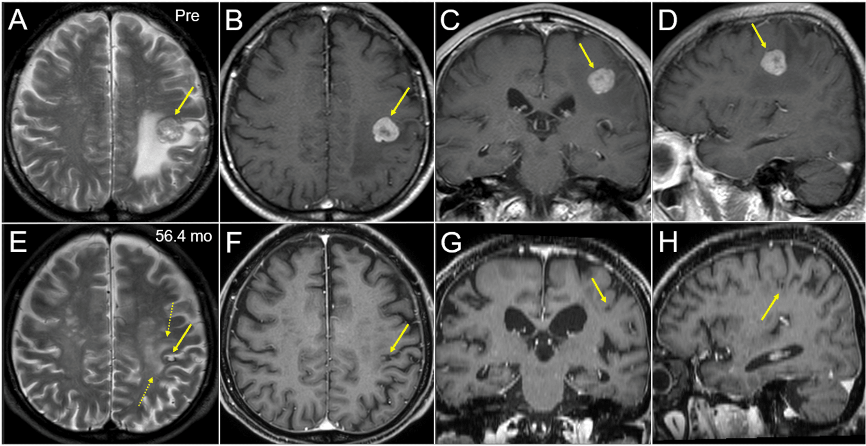 Cureus FiveYear Sustained Complete Remission With Minimal Adverse