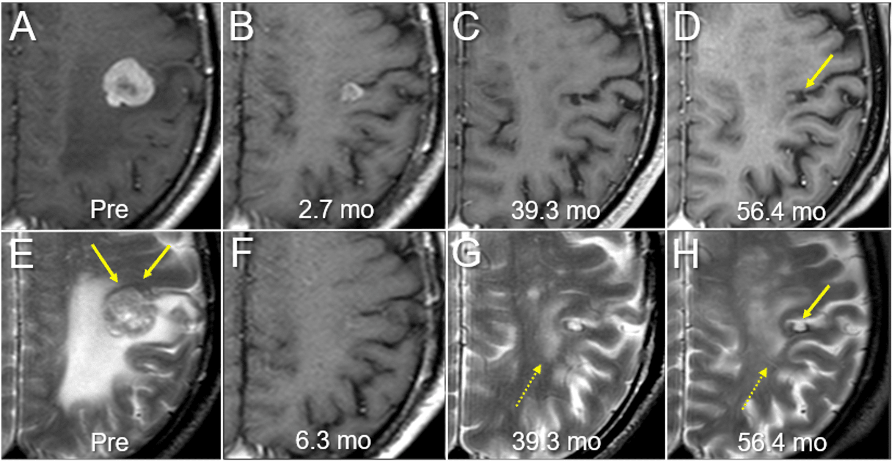 Cureus FiveYear Sustained Complete Remission With Minimal Adverse