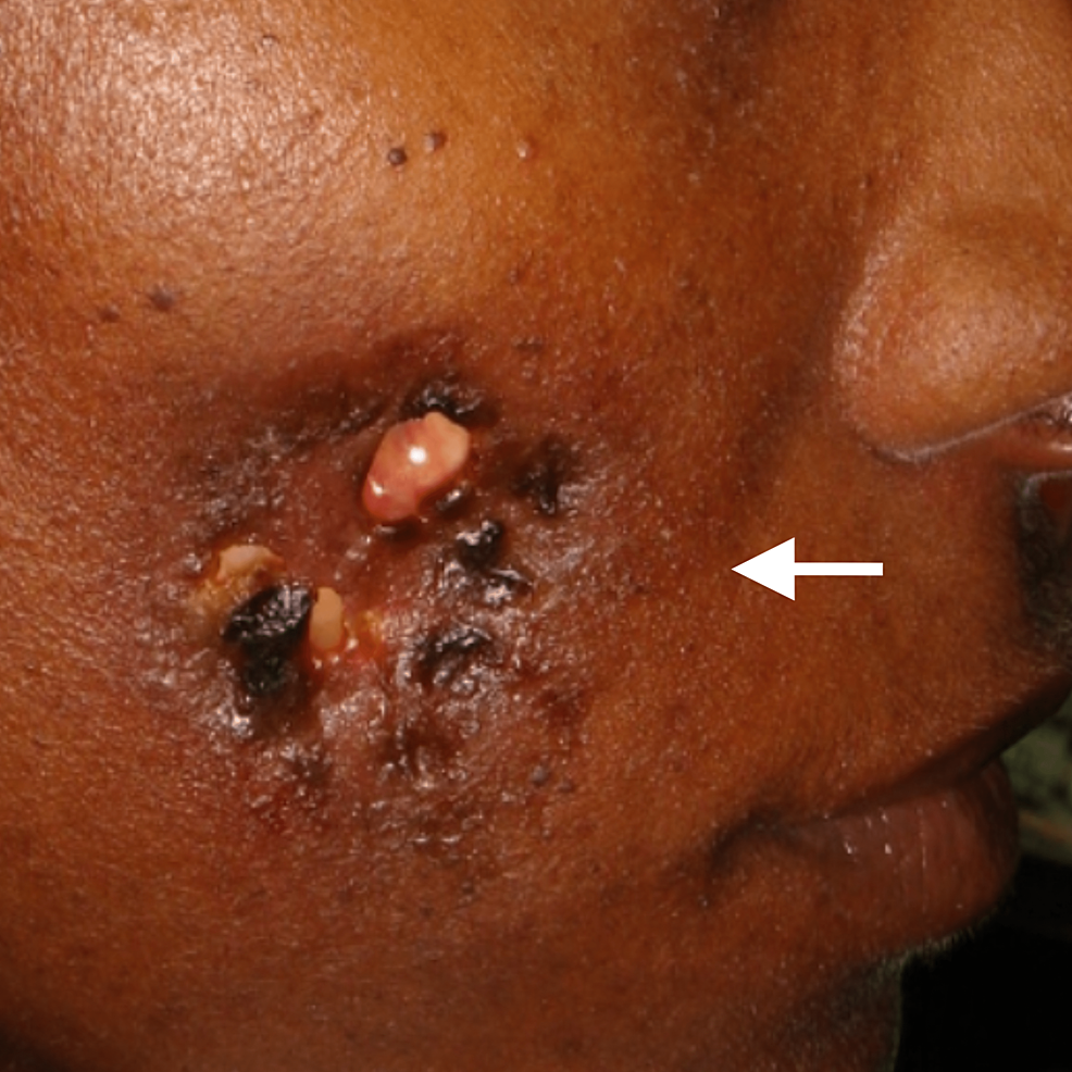 Cureus, Facial Presentation of Crohn's Disease: Report of a Case
